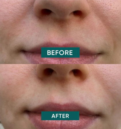 APRICOT przeciwzmarszczkowe plastry na bruzdy nosowo-wargowe „kiss it better“