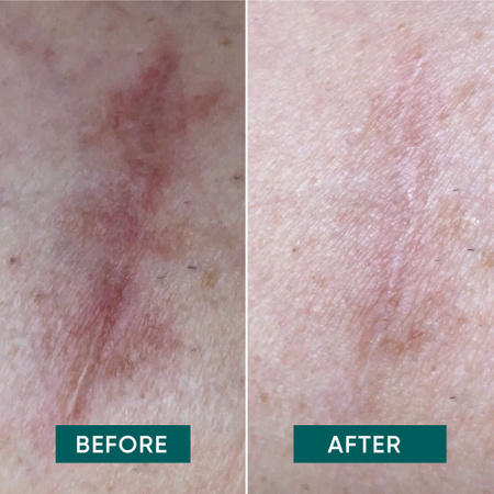 APRICOT wygładzające płatki na blizny "scar, scar away" w wersji mini